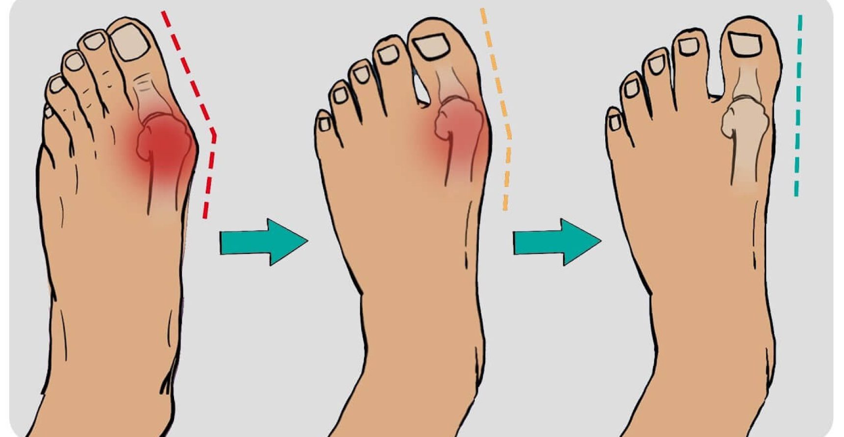 how-to-fix-bunions-in-5-steps