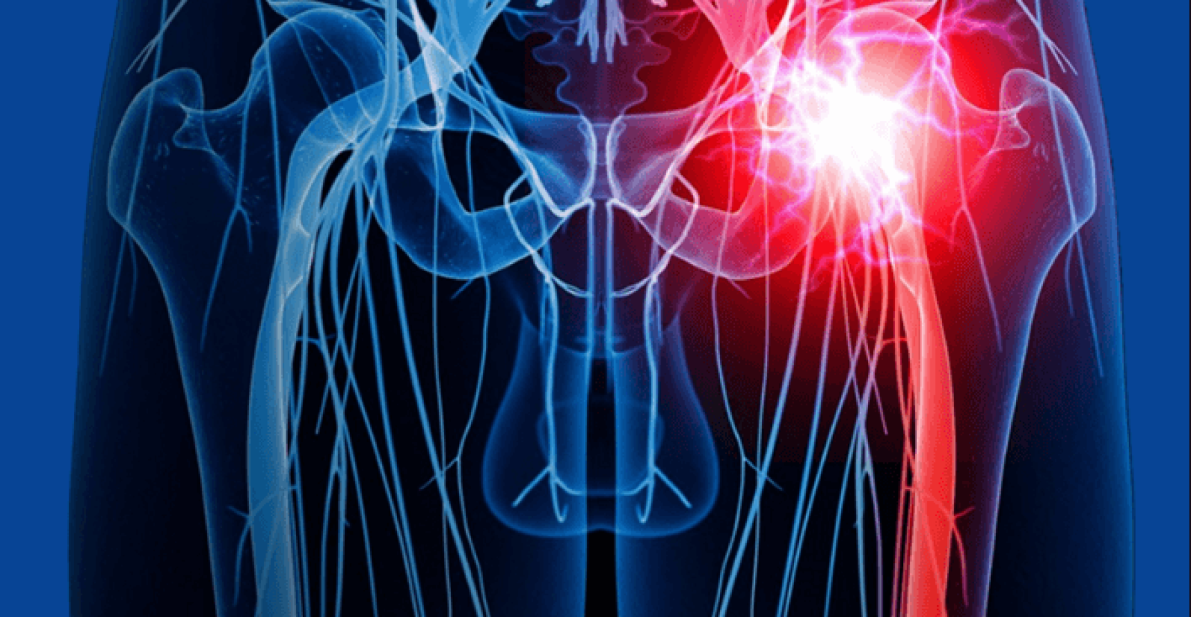 isxialgia-1