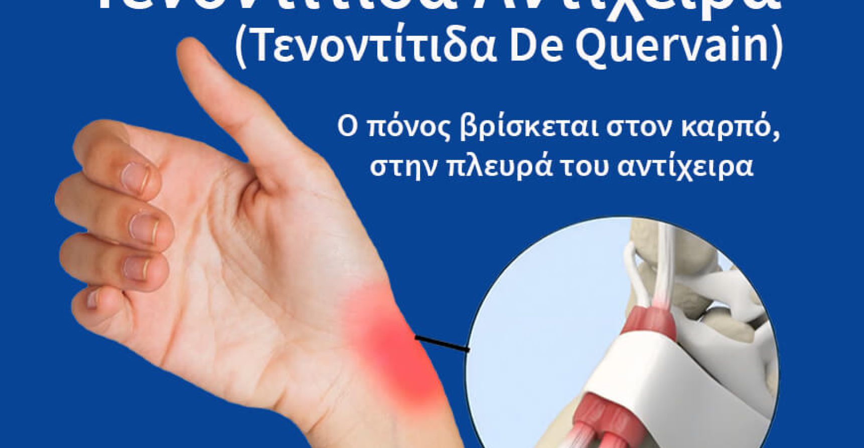 tenontitida-antixeira-tenontitida-de-quervain-tenontitida-nte-kerven-1